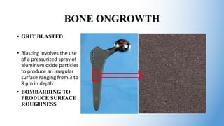 BONE ONGROWTH
• GRIT BLASTED
• Blasting involves the use
of a pressurized spray of
aluminum oxide particles
to produce an irregular
surface ranging from 3 to
8 μm in depth
• BOMBARDING TO
PRODUCE SURFACE
ROUGHNESS
10
 