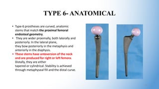 TYPE 6- ANATOMICAL
• Type-6 prostheses are curved, anatomic
stems that match the proximal femoral
endosteal geometry.
• They are wider proximally, both laterally and
posteriorly. In the lateral plane,
they bow posteriorly in the metaphysis and
anteriorly in the diaphysis.
• These stems have anteversion of the neck
and are produced for right or left femora.
Distally, they are either
tapered or cylindrical. Stability is achieved
through metaphyseal fill and the distal curve.
20
 