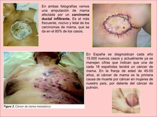 En ambas fotografías vemos una amputación de mama afectada por un  carcinoma ductal infiltrante.  Es el más frecuente, nocivo y letal de los carcinomas de mama, que se da en el 80% de los casos. En España se diagnostican cada año 15.000 nuevos casos   y actualmente ya se manejan cifras que indican que una de cada 18 españolas tendrá un cáncer de mama. En la franja de edad de 45-55 años, el cáncer de mama es la primera causa de muerte por cáncer en mujeres de nuestro país, por delante del cáncer de pulmón. 