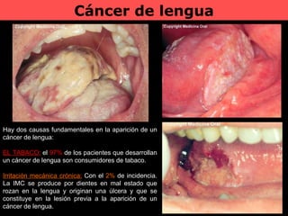 Cáncer de lengua Hay dos causas fundamentales en la aparición de un cáncer de lengua: EL TABACO:  el  97%  de los pacientes que desarrollan un cáncer de lengua son consumidores de tabaco.  Irritación mecánica crónica:  Con el  2%  de incidencia. La IMC se produce por dientes en mal estado que rozan en la lengua y originan una úlcera y que se constituye en la lesión previa a la aparición de un cáncer de lengua. 