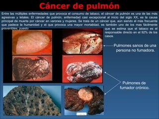 Cáncer de pulmón Pulmones de  fumador crónico. Pulmones sanos de una  persona no fumadora. Entre las múltiples enfermedades que provoca el consumo de tabaco, el cáncer de pulmón es una de las más agresivas y letales. El cáncer de pulmón, enfermedad casi excepcional al inicio del siglo XX, es la causa principal de muerte por cáncer en varones y mujeres. Se trata de un cáncer que, aún siendo el más frecuente que padece la humanidad y el que provoca una mayor mortalidad, es también uno de los mas fácilmente prevenibles, puesto que se estima que el tabaco es el responsable directo en el 92% de los casos.   