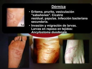 Dérmica
• Eritema, prurito, vesiculación
  "sabañones". Cicatriz
  residual, papulas. Infección bacteriana
  secundaria.
• Invasión y migración de larvas.
  Larvas en reposo en tejidos:
  Ancylostoma duodenale.
 