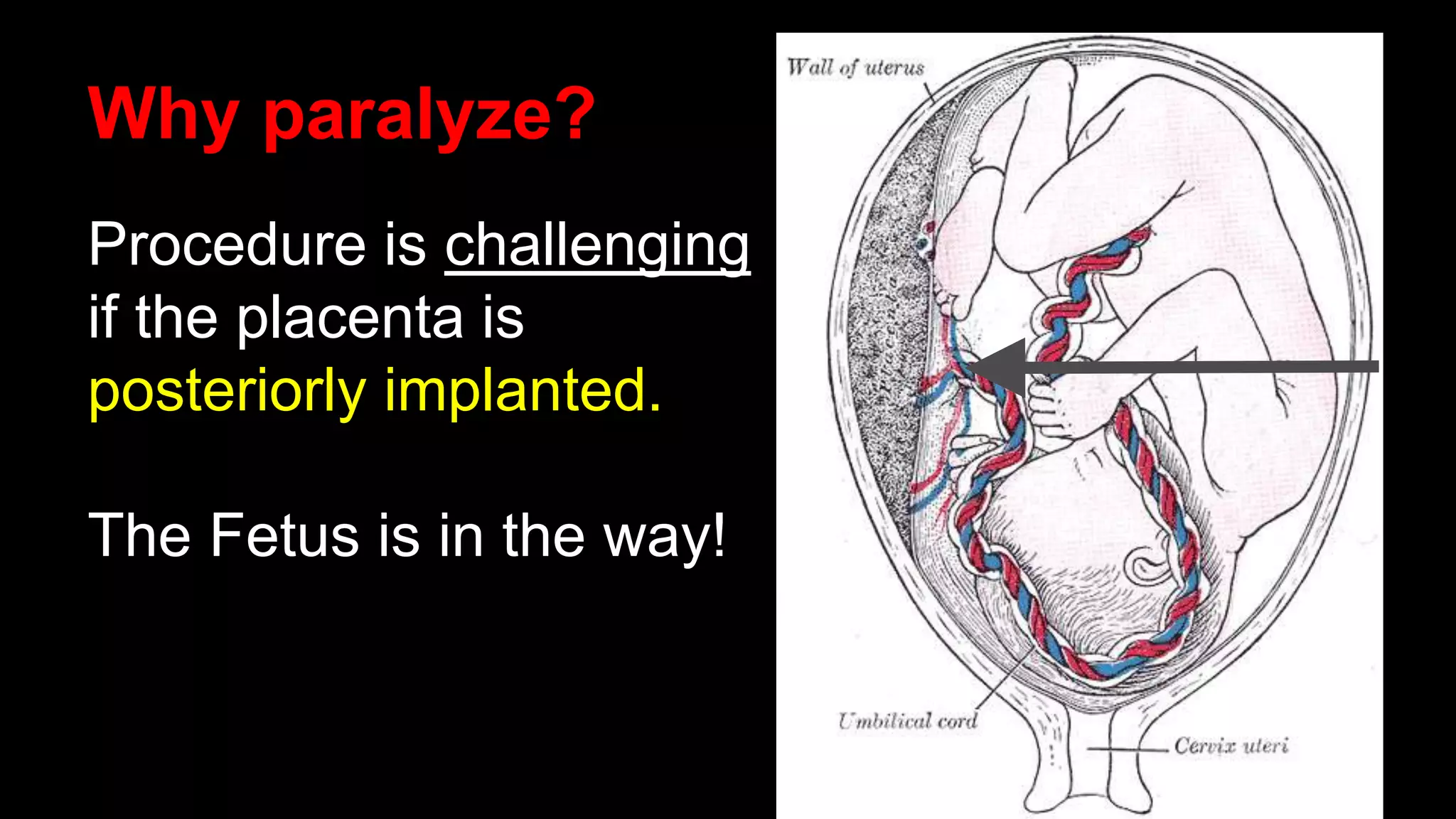 Why paralyze?
Procedure is challenging
if the placenta is
posteriorly implanted.
The Fetus is in the way!
 