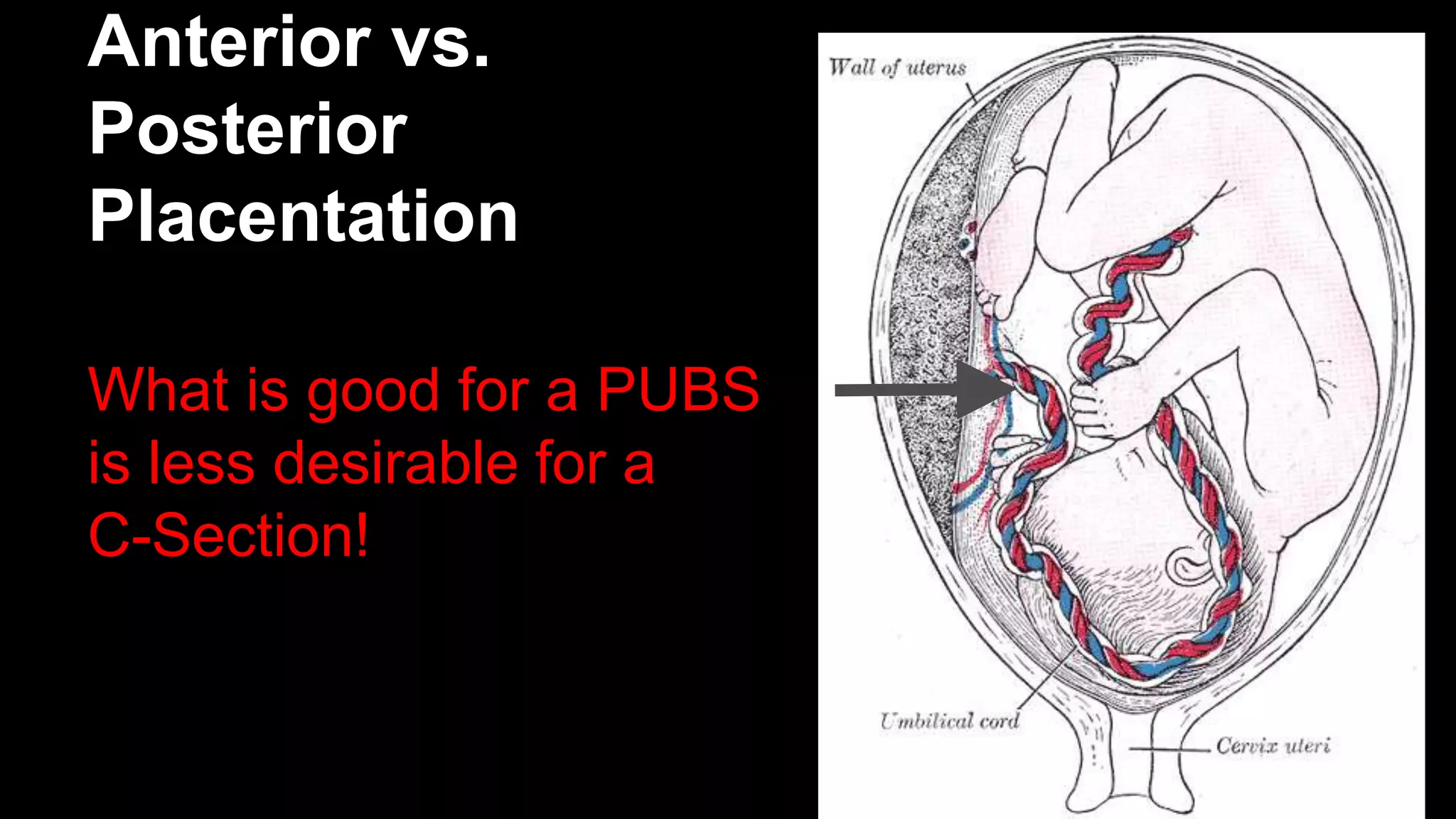 Anterior vs.
Posterior
Placentation
What is good for a PUBS
is less desirable for a
C-Section!
 