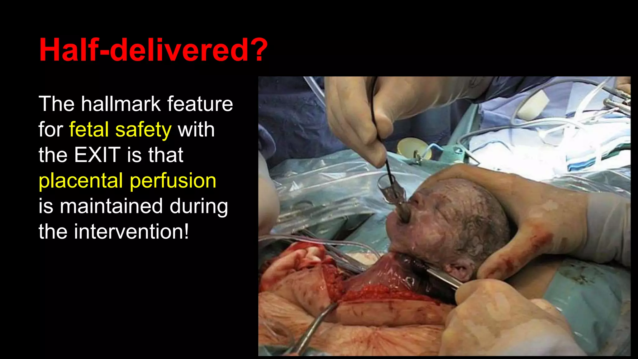 Half-delivered?
The hallmark feature
for fetal safety with
the EXIT is that
placental perfusion
is maintained during
the intervention!
 