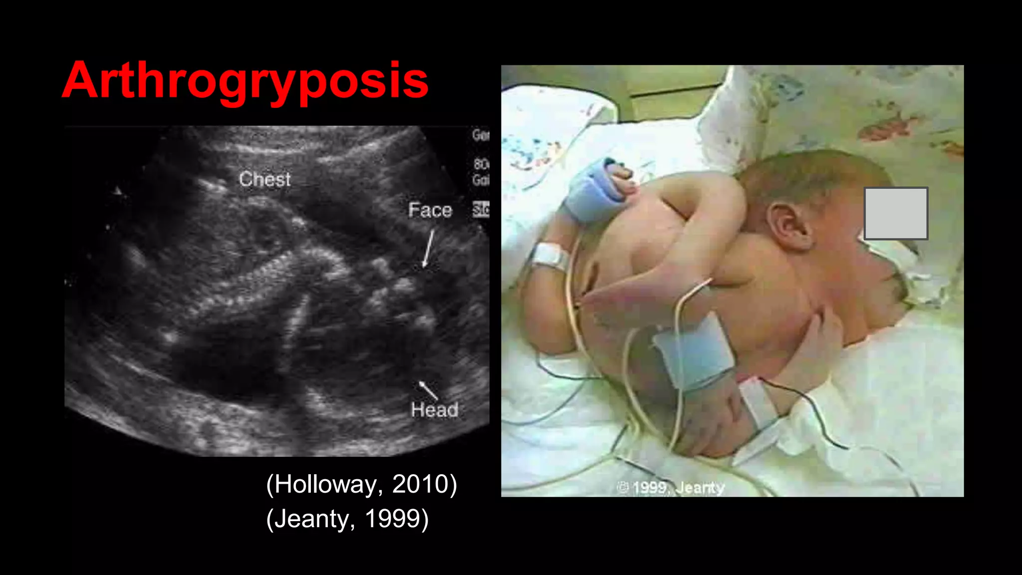 Arthrogryposis
(Holloway, 2010)
(Jeanty, 1999)
 