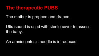 The therapeutic PUBS
The mother is prepped and draped.
Ultrasound is used with sterile cover to assess
the baby.
An amniocentesis needle is introduced.
 
