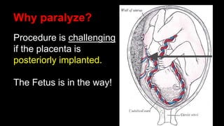 Why paralyze?
Procedure is challenging
if the placenta is
posteriorly implanted.
The Fetus is in the way!
 
