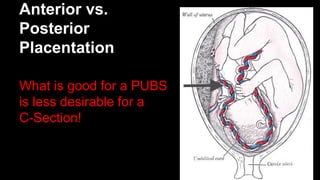 Anterior vs.
Posterior
Placentation
What is good for a PUBS
is less desirable for a
C-Section!
 