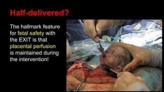 Half-delivered?
The hallmark feature
for fetal safety with
the EXIT is that
placental perfusion
is maintained during
the intervention!
 