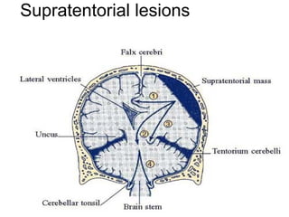 Supratentorial lesions
 