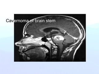 Cavernoma of brain stem
 