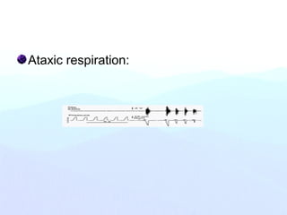 Ataxic respiration:
 