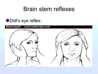 Brain stem reflexes
Doll’s eye reflex:
 