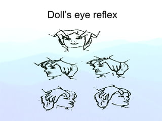 Doll’s eye reflex
 