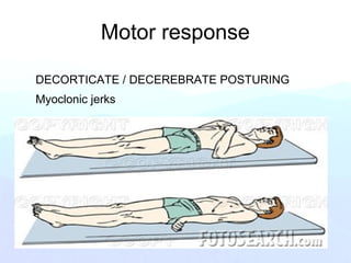 Motor response
DECORTICATE / DECEREBRATE POSTURING
Myoclonic jerks
 