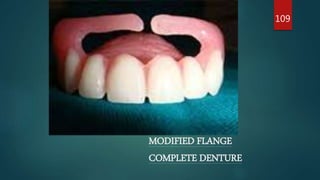 MODIFIED FLANGE
COMPLETE DENTURE
109
 