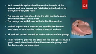 123• An irreversible hydrocolloid impression is made of the
prongs, and new prongs are fabricated using heat-cured
methyl methacrylate resin.
• The prongs are then placed into the skin grafted pockets
and a final impression is made
• The prongs are withdrawn with the final impression.
• A final impression is made of the mandibular denture
bearing area, and master casts are poured in stone.
• All occlusal records are taken without the use of the prongs
• small retentive grooves are placed in the prongs to ensure a
good chemical-mechanical bond between the prongs and
the denture during processing.
 