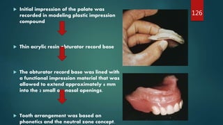  Initial impression of the palate was
recorded in modeling plastic impression
compound
 Thin acrylic resin obturator record base
 The obturator record base was lined with
a functional impression material that was
allowed to extend approximately 6 mm
into the 2 small oronasal openings.
 Tooth arrangement was based on
phonetics and the neutral zone concept.
126
 