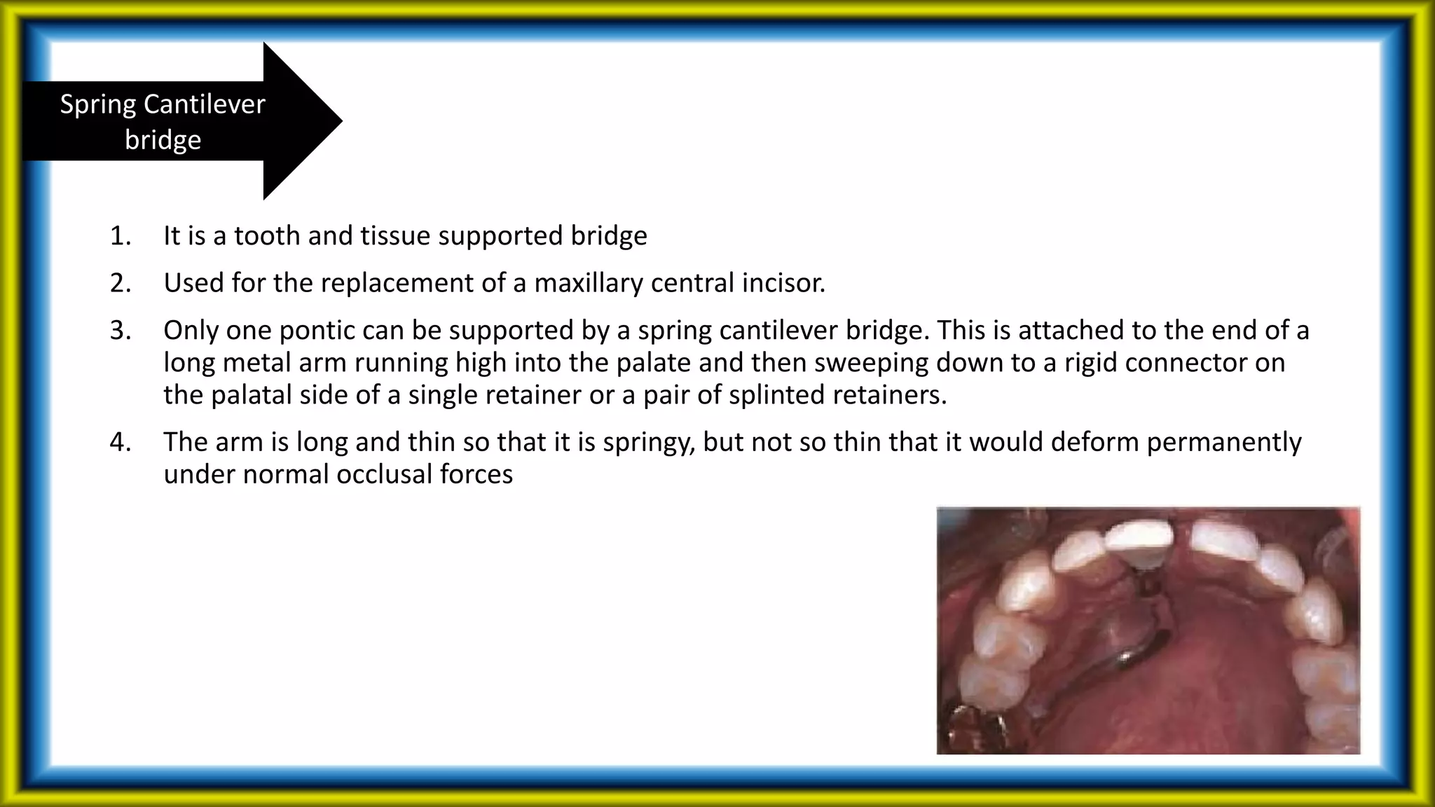 1. It is a tooth and tissue supported bridge
2. Used for the replacement of a maxillary central incisor.
3. Only one pontic can be supported by a spring cantilever bridge. This is attached to the end of a
long metal arm running high into the palate and then sweeping down to a rigid connector on
the palatal side of a single retainer or a pair of splinted retainers.
4. The arm is long and thin so that it is springy, but not so thin that it would deform permanently
under normal occlusal forces
Spring Cantilever
bridge
 