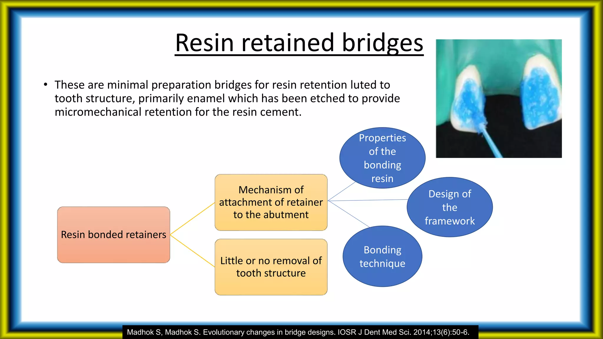 • These are minimal preparation bridges for resin retention luted to
tooth structure, primarily enamel which has been etched to provide
micromechanical retention for the resin cement.
Resin retained bridges
Madhok S, Madhok S. Evolutionary changes in bridge designs. IOSR J Dent Med Sci. 2014;13(6):50-6.
Resin bonded retainers
Mechanism of
attachment of retainer
to the abutment
Little or no removal of
tooth structure
Properties
of the
bonding
resin
Design of
the
framework
Bonding
technique
 