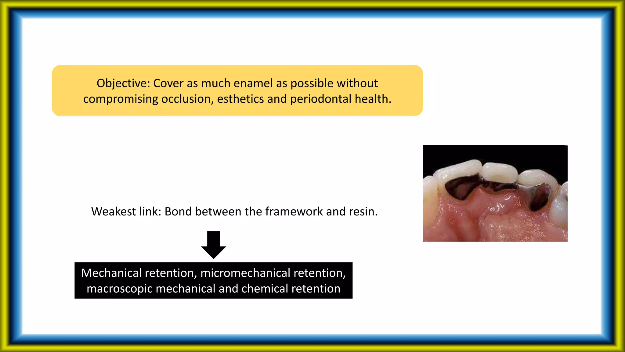 Objective: Cover as much enamel as possible without
compromising occlusion, esthetics and periodontal health.
Mechanical retention, micromechanical retention,
macroscopic mechanical and chemical retention
Weakest link: Bond between the framework and resin.
 