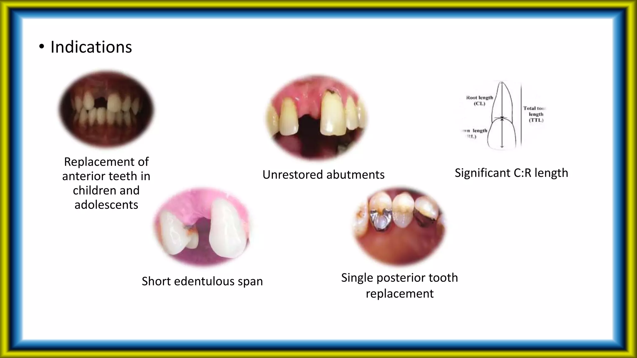 • Indications
Replacement of
anterior teeth in
children and
adolescents
Short edentulous span
Unrestored abutments
Single posterior tooth
replacement
Significant C:R length
 