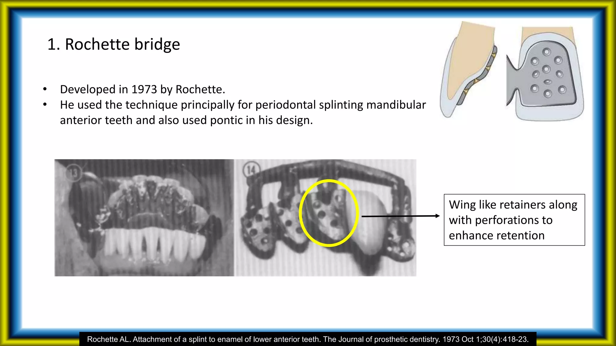 1. Rochette bridge
Rochette AL. Attachment of a splint to enamel of lower anterior teeth. The Journal of prosthetic dentistry. 1973 Oct 1;30(4):418-23.
• Developed in 1973 by Rochette.
• He used the technique principally for periodontal splinting mandibular
anterior teeth and also used pontic in his design.
Wing like retainers along
with perforations to
enhance retention
 