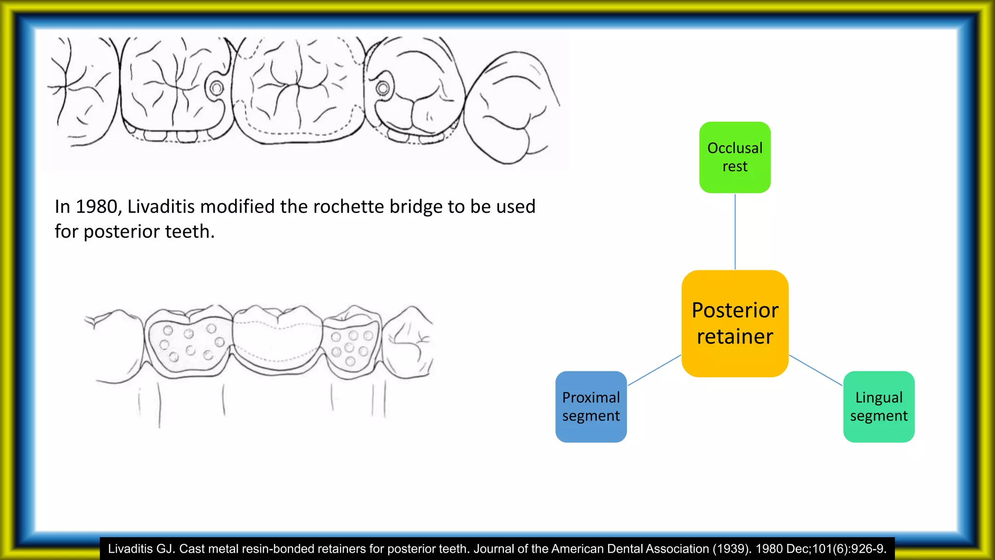 Livaditis GJ. Cast metal resin-bonded retainers for posterior teeth. Journal of the American Dental Association (1939). 1980 Dec;101(6):926-9.
In 1980, Livaditis modified the rochette bridge to be used
for posterior teeth.
Posterior
retainer
Occlusal
rest
Lingual
segment
Proximal
segment
 