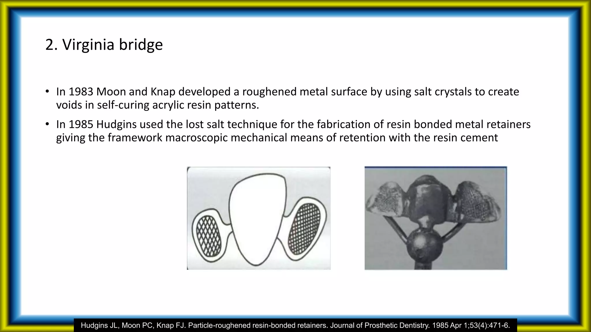 2. Virginia bridge
• In 1983 Moon and Knap developed a roughened metal surface by using salt crystals to create
voids in self-curing acrylic resin patterns.
• In 1985 Hudgins used the lost salt technique for the fabrication of resin bonded metal retainers
giving the framework macroscopic mechanical means of retention with the resin cement
Hudgins JL, Moon PC, Knap FJ. Particle-roughened resin-bonded retainers. Journal of Prosthetic Dentistry. 1985 Apr 1;53(4):471-6.
 