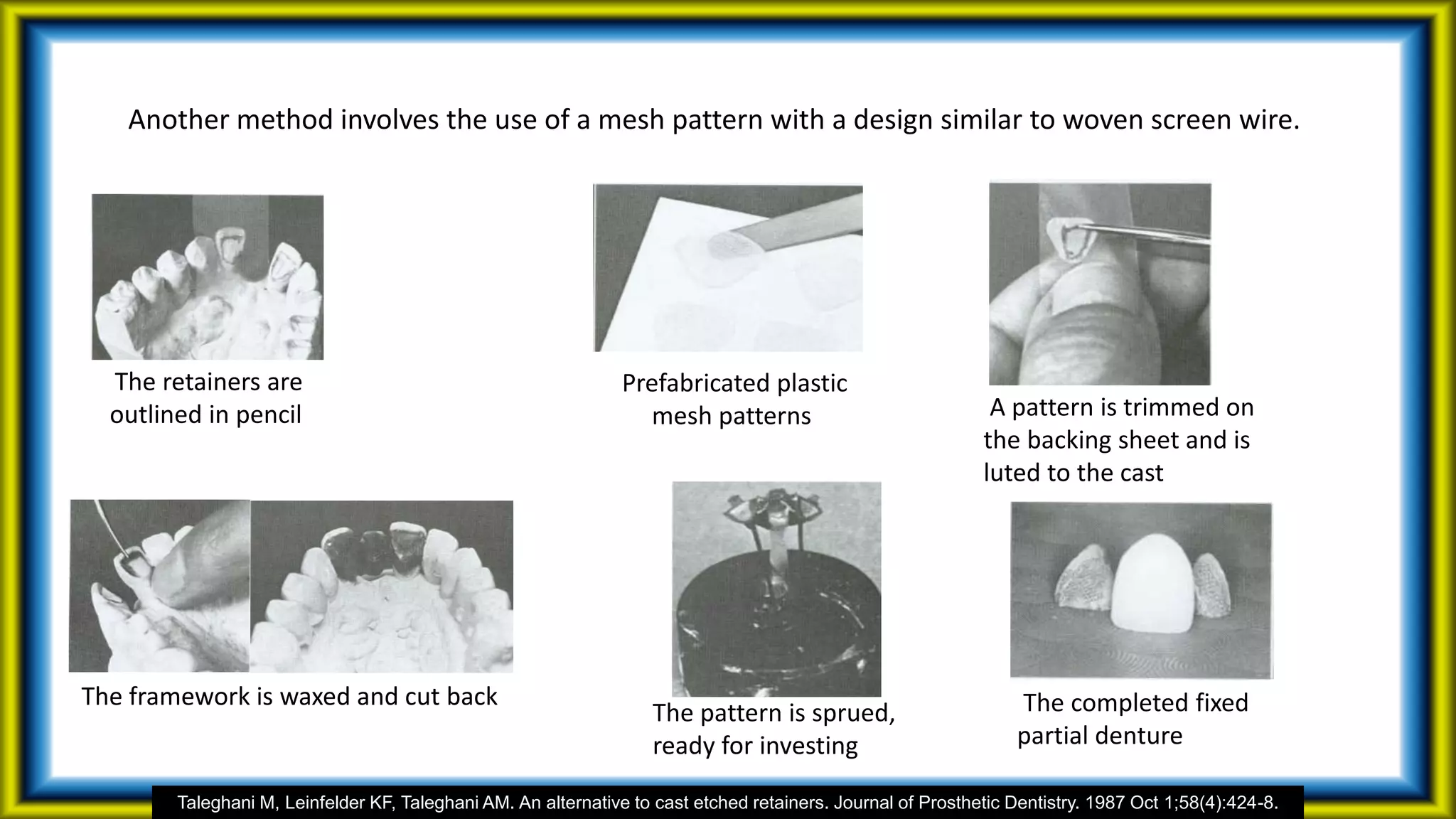 Another method involves the use of a mesh pattern with a design similar to woven screen wire.
Taleghani M, Leinfelder KF, Taleghani AM. An alternative to cast etched retainers. Journal of Prosthetic Dentistry. 1987 Oct 1;58(4):424-8.
The retainers are
outlined in pencil
Prefabricated plastic
mesh patterns A pattern is trimmed on
the backing sheet and is
luted to the cast
The framework is waxed and cut back
The pattern is sprued,
ready for investing
The completed fixed
partial denture
 