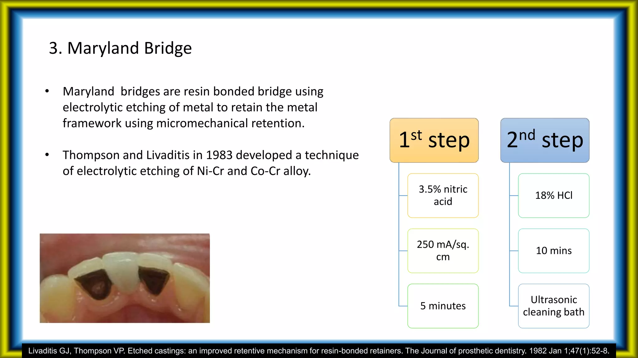 3. Maryland Bridge
• Maryland bridges are resin bonded bridge using
electrolytic etching of metal to retain the metal
framework using micromechanical retention.
• Thompson and Livaditis in 1983 developed a technique
of electrolytic etching of Ni-Cr and Co-Cr alloy.
1st step
3.5% nitric
acid
250 mA/sq.
cm
5 minutes
2nd step
18% HCl
10 mins
Ultrasonic
cleaning bath
Livaditis GJ, Thompson VP. Etched castings: an improved retentive mechanism for resin-bonded retainers. The Journal of prosthetic dentistry. 1982 Jan 1;47(1):52-8.
 