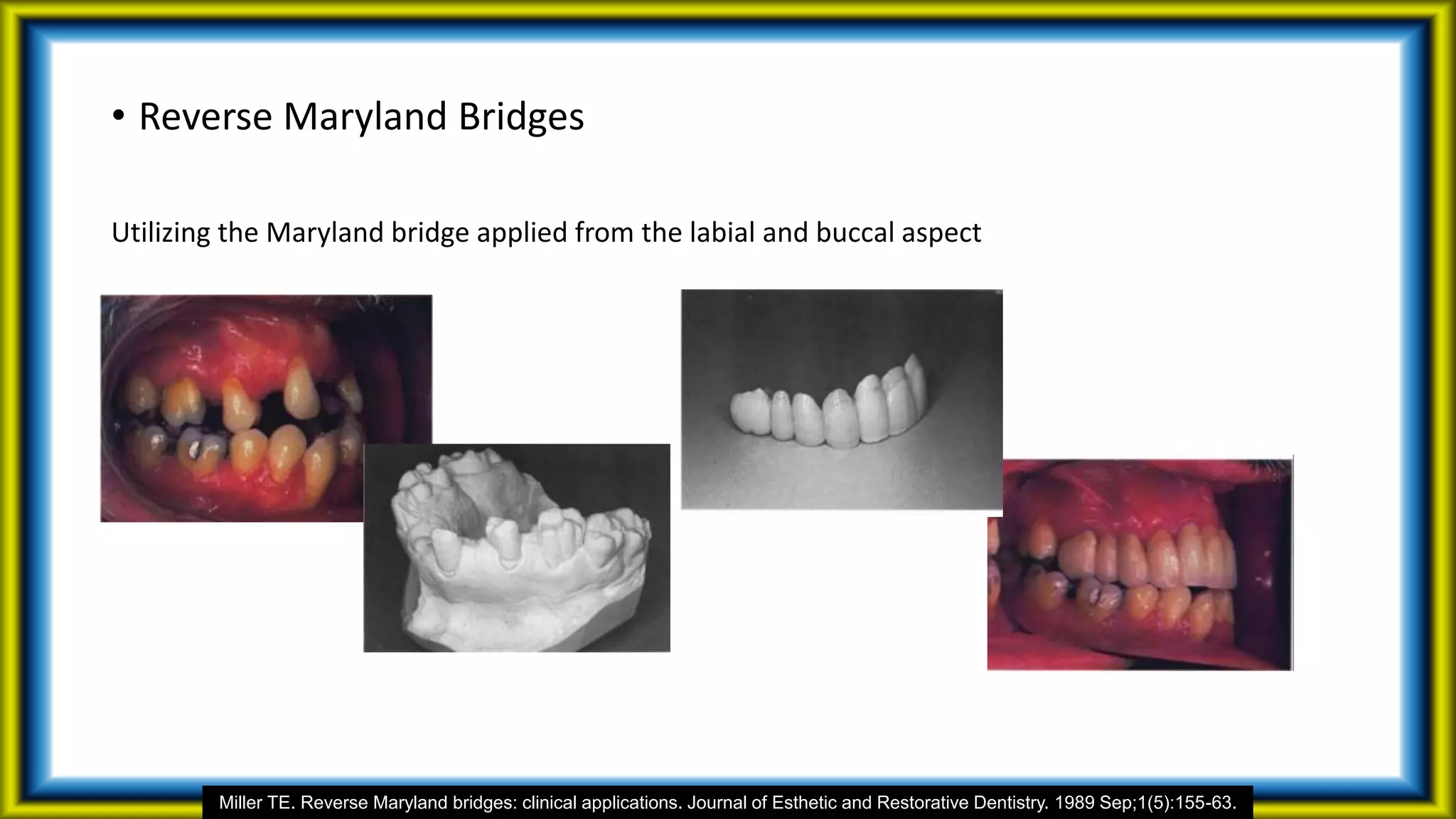 • Reverse Maryland Bridges
Utilizing the Maryland bridge applied from the labial and buccal aspect
Miller TE. Reverse Maryland bridges: clinical applications. Journal of Esthetic and Restorative Dentistry. 1989 Sep;1(5):155-63.
 