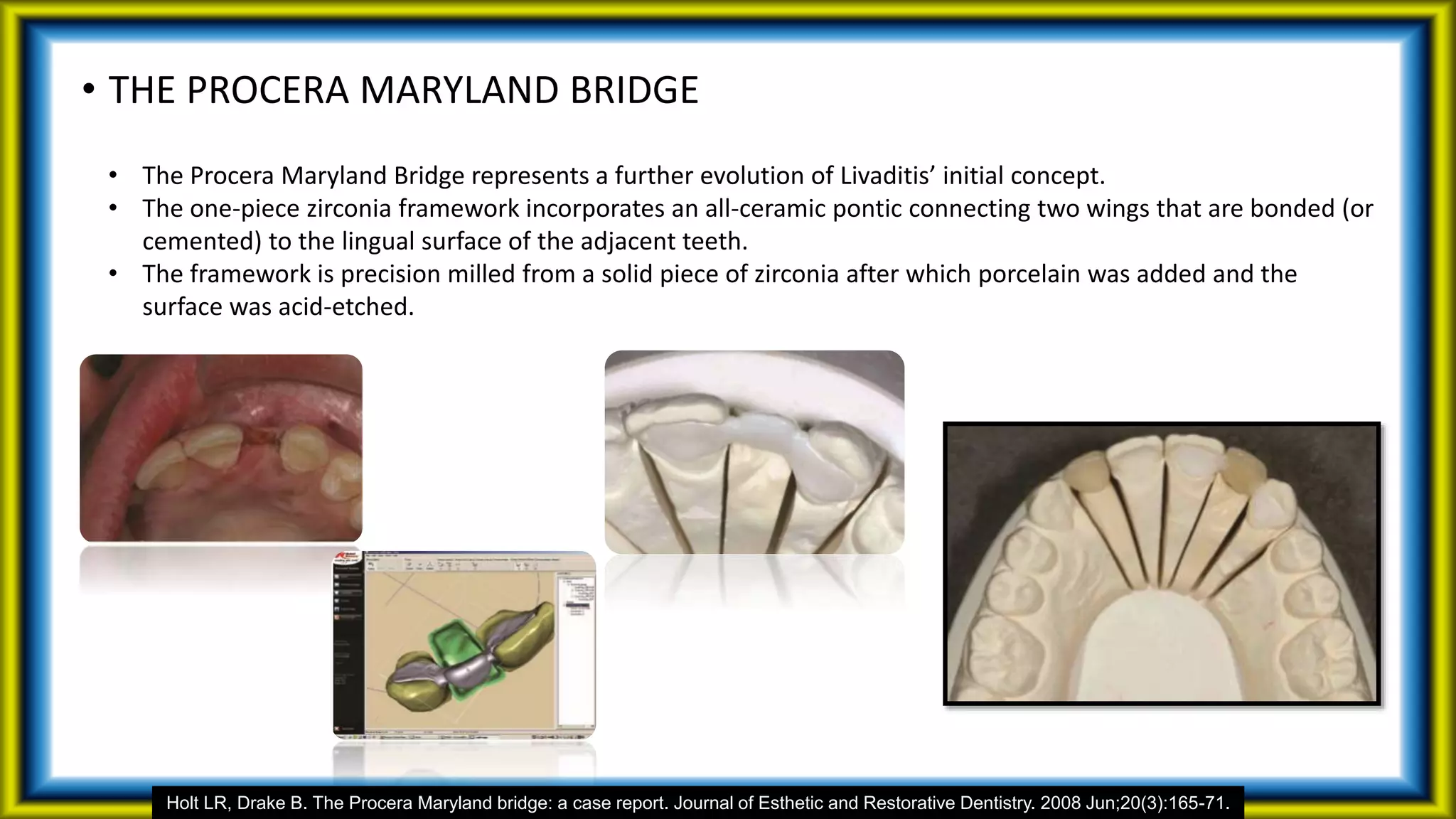 • THE PROCERA MARYLAND BRIDGE
• The Procera Maryland Bridge represents a further evolution of Livaditis’ initial concept.
• The one-piece zirconia framework incorporates an all-ceramic pontic connecting two wings that are bonded (or
cemented) to the lingual surface of the adjacent teeth.
• The framework is precision milled from a solid piece of zirconia after which porcelain was added and the
surface was acid-etched.
Holt LR, Drake B. The Procera Maryland bridge: a case report. Journal of Esthetic and Restorative Dentistry. 2008 Jun;20(3):165-71.
 