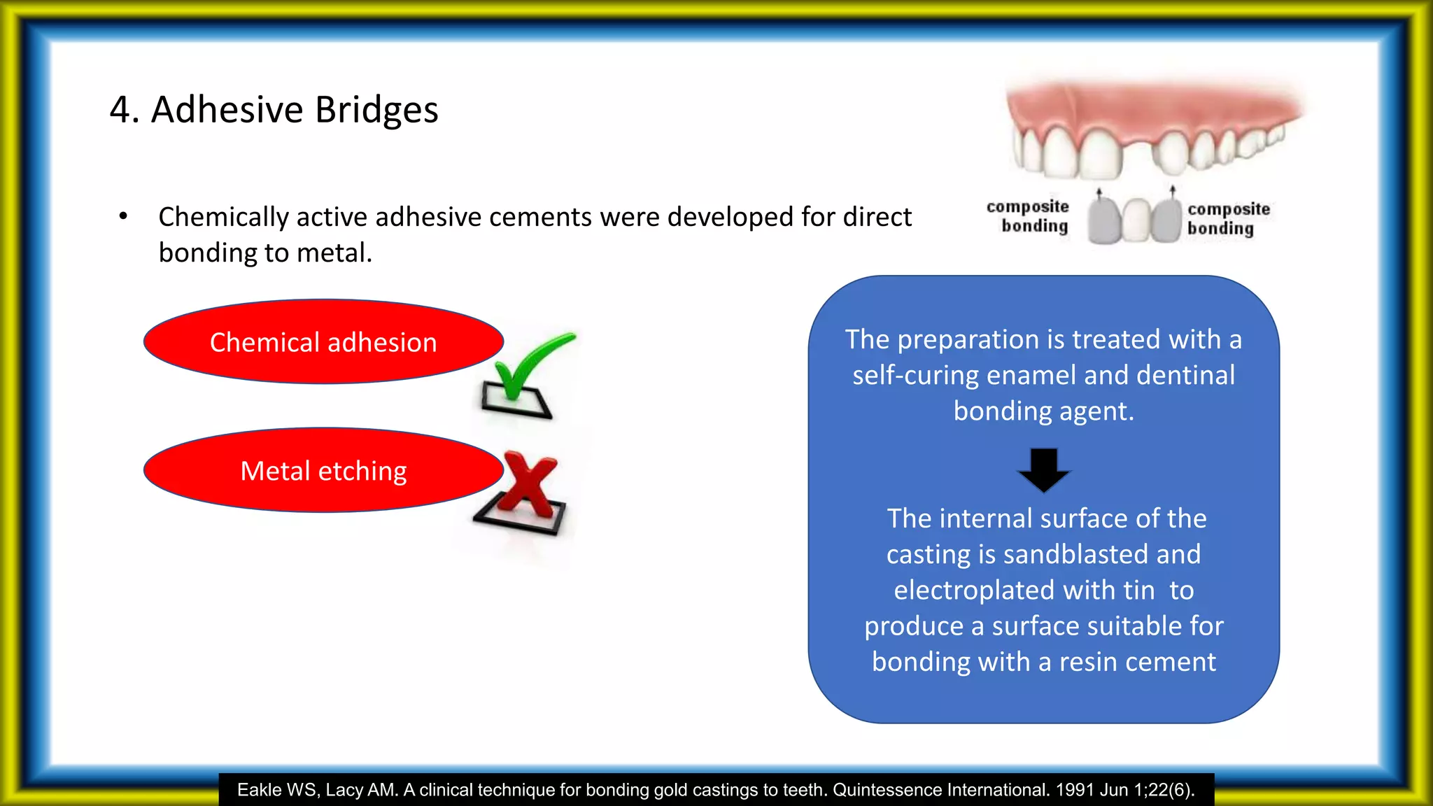 4. Adhesive Bridges
• Chemically active adhesive cements were developed for direct
bonding to metal.
Metal etching
Chemical adhesion
Eakle WS, Lacy AM. A clinical technique for bonding gold castings to teeth. Quintessence International. 1991 Jun 1;22(6).
The preparation is treated with a
self-curing enamel and dentinal
bonding agent.
The internal surface of the
casting is sandblasted and
electroplated with tin to
produce a surface suitable for
bonding with a resin cement
 