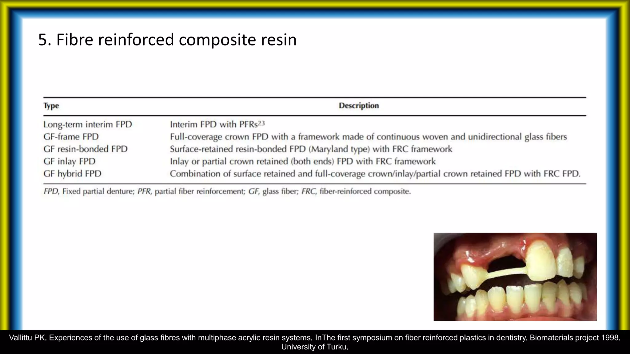 5. Fibre reinforced composite resin
Vallittu PK. Experiences of the use of glass fibres with multiphase acrylic resin systems. InThe first symposium on fiber reinforced plastics in dentistry. Biomaterials project 1998.
University of Turku.
 