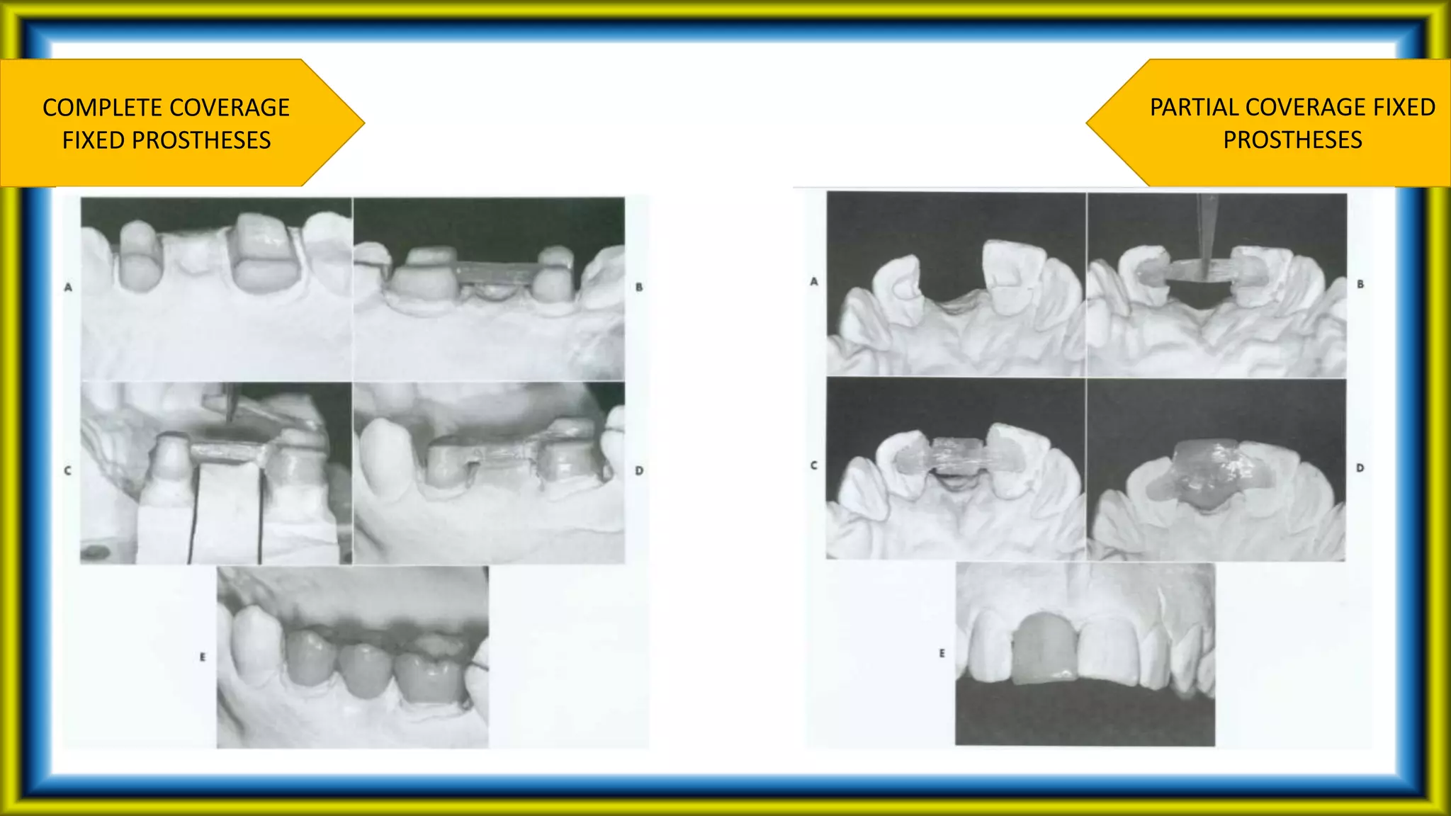 COMPLETE COVERAGE
FIXED PROSTHESES
PARTIAL COVERAGE FIXED
PROSTHESES
 