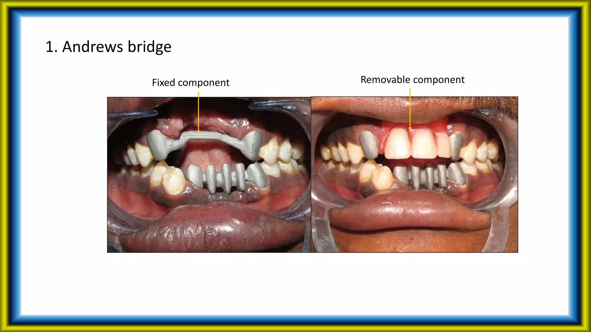 1. Andrews bridge
Fixed component Removable component
 