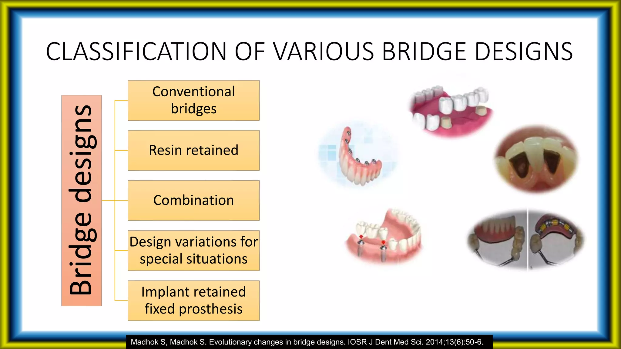CLASSIFICATION OF VARIOUS BRIDGE DESIGNS
Bridgedesigns Conventional
bridges
Resin retained
Combination
Design variations for
special situations
Implant retained
fixed prosthesis
Madhok S, Madhok S. Evolutionary changes in bridge designs. IOSR J Dent Med Sci. 2014;13(6):50-6.
 