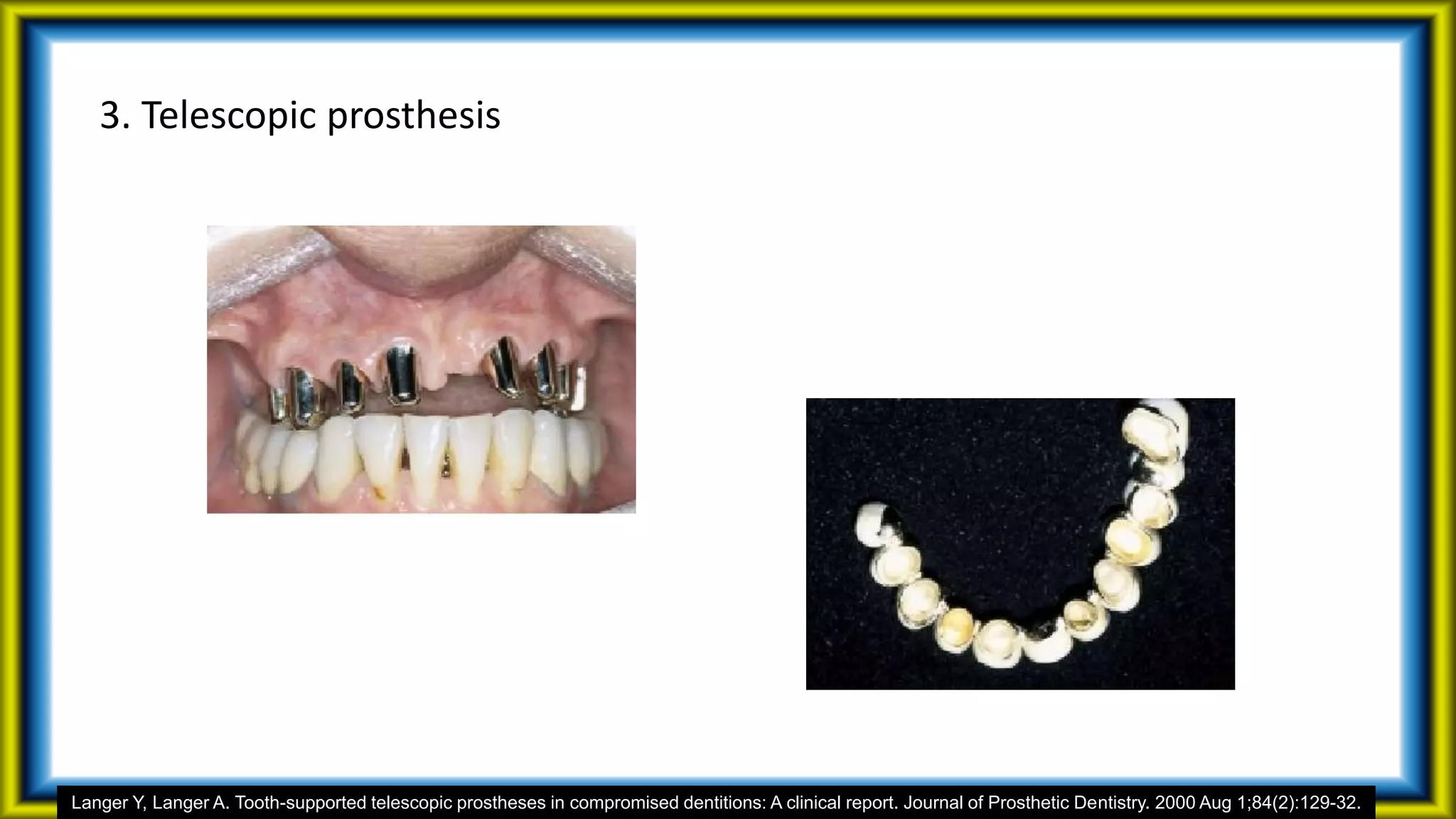 3. Telescopic prosthesis
Langer Y, Langer A. Tooth-supported telescopic prostheses in compromised dentitions: A clinical report. Journal of Prosthetic Dentistry. 2000 Aug 1;84(2):129-32.
 