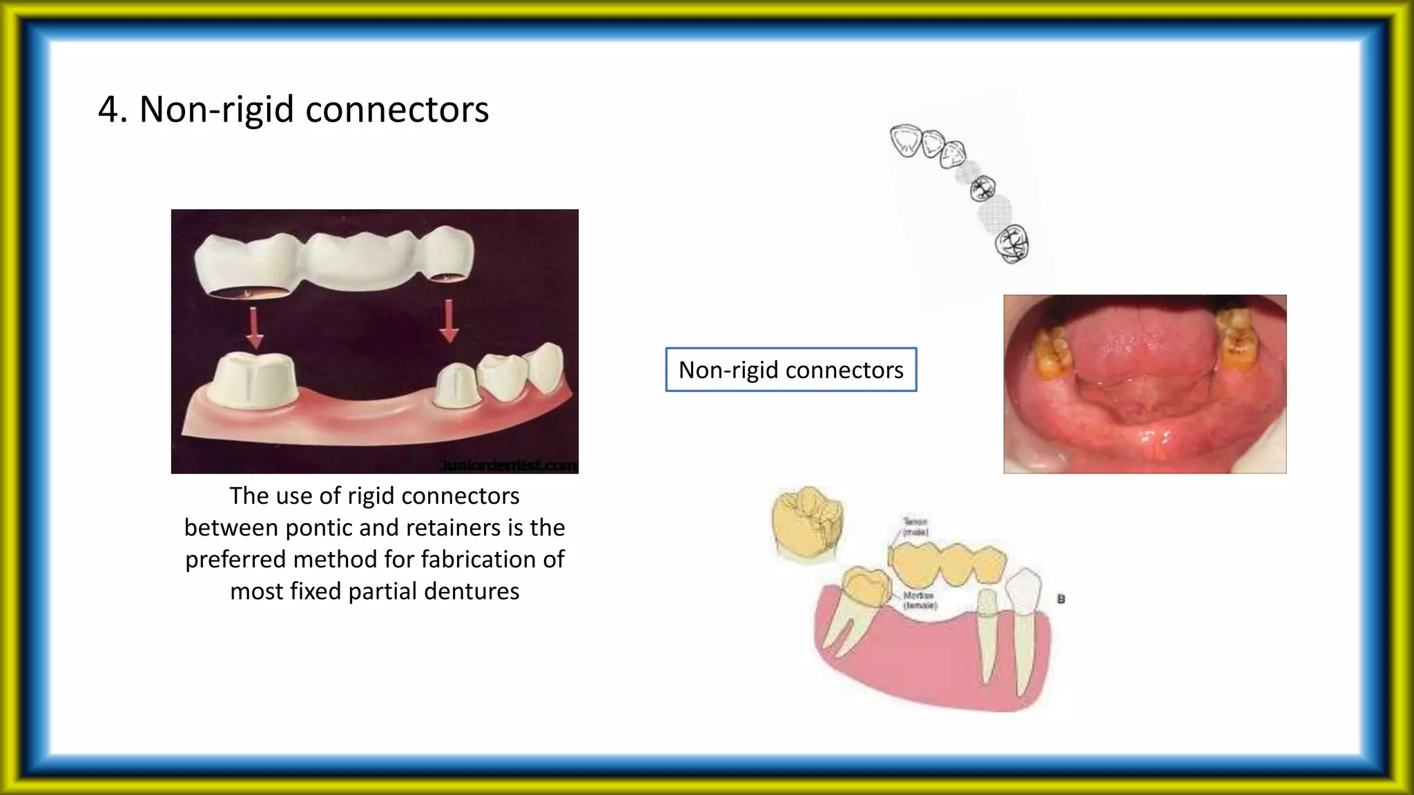 4. Non-rigid connectors
Non-rigid connectors
The use of rigid connectors
between pontic and retainers is the
preferred method for fabrication of
most fixed partial dentures
 
