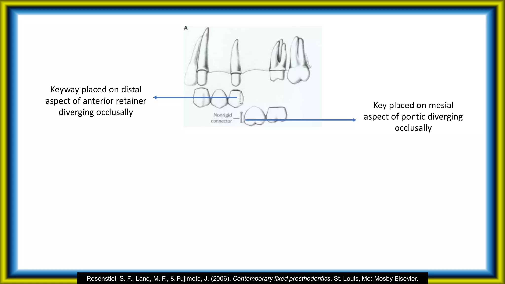 Keyway placed on distal
aspect of anterior retainer
diverging occlusally
Key placed on mesial
aspect of pontic diverging
occlusally
Rosenstiel, S. F., Land, M. F., & Fujimoto, J. (2006). Contemporary fixed prosthodontics. St. Louis, Mo: Mosby Elsevier.
 