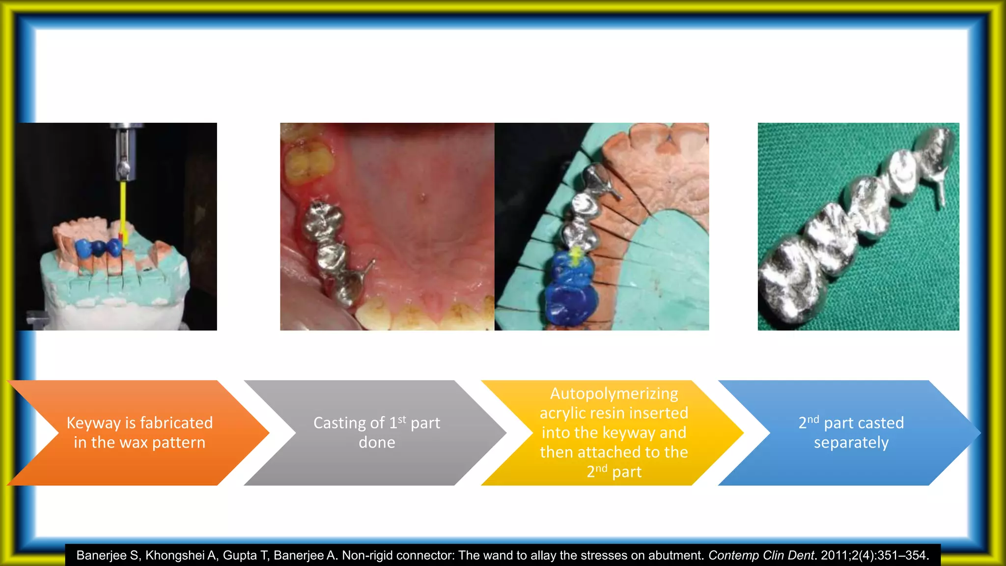 Keyway is fabricated
in the wax pattern
Casting of 1st part
done
Autopolymerizing
acrylic resin inserted
into the keyway and
then attached to the
2nd part
2nd part casted
separately
Banerjee S, Khongshei A, Gupta T, Banerjee A. Non-rigid connector: The wand to allay the stresses on abutment. Contemp Clin Dent. 2011;2(4):351–354.
 