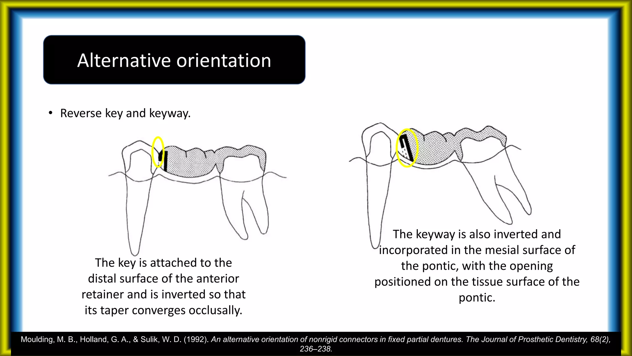 • Reverse key and keyway.
Alternative orientation
The key is attached to the
distal surface of the anterior
retainer and is inverted so that
its taper converges occlusally.
The keyway is also inverted and
incorporated in the mesial surface of
the pontic, with the opening
positioned on the tissue surface of the
pontic.
Moulding, M. B., Holland, G. A., & Sulik, W. D. (1992). An alternative orientation of nonrigid connectors in fixed partial dentures. The Journal of Prosthetic Dentistry, 68(2),
236–238.
 