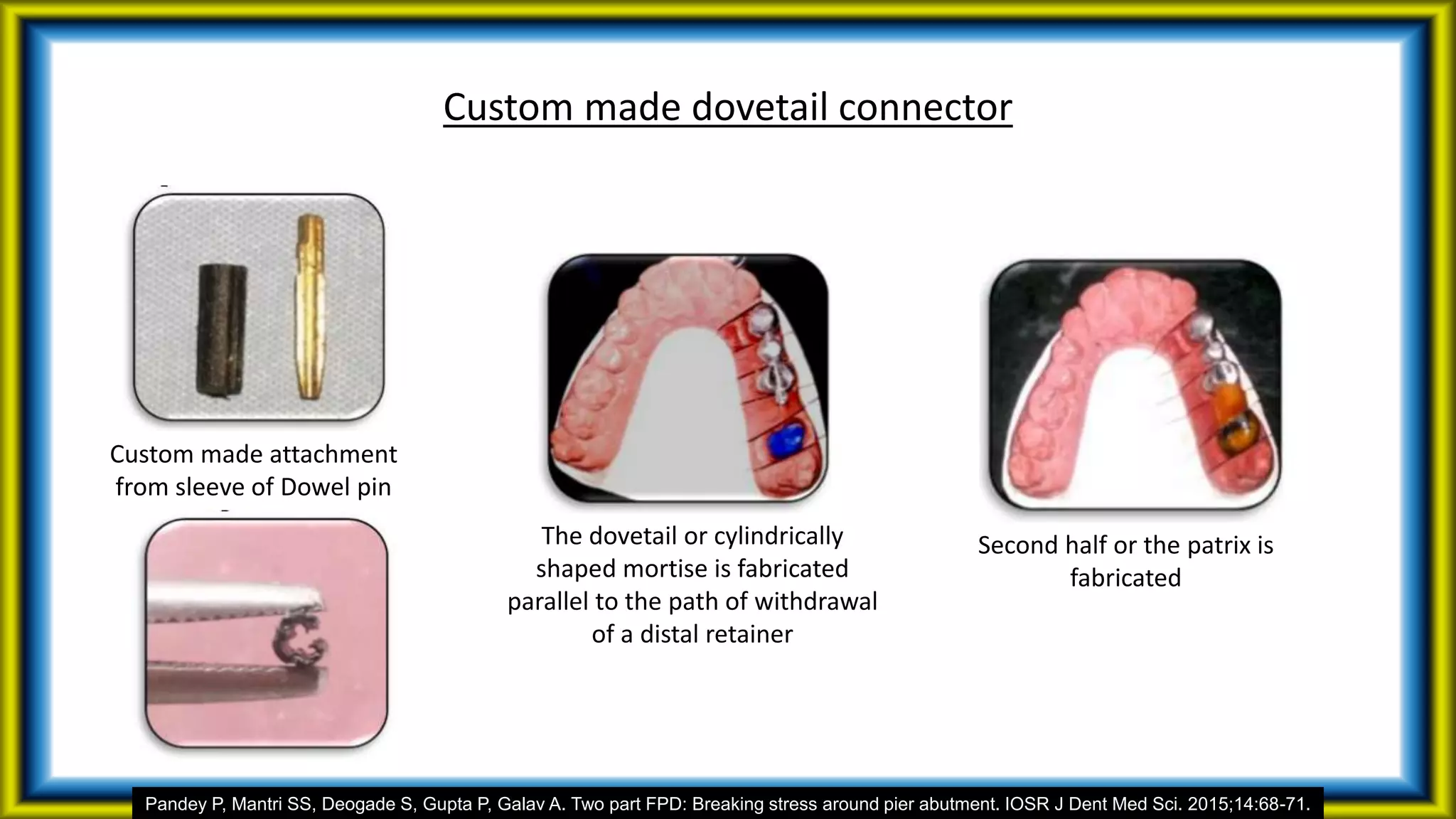 Custom made dovetail connector
Custom made attachment
from sleeve of Dowel pin
The dovetail or cylindrically
shaped mortise is fabricated
parallel to the path of withdrawal
of a distal retainer
Second half or the patrix is
fabricated
Pandey P, Mantri SS, Deogade S, Gupta P, Galav A. Two part FPD: Breaking stress around pier abutment. IOSR J Dent Med Sci. 2015;14:68-71.
 