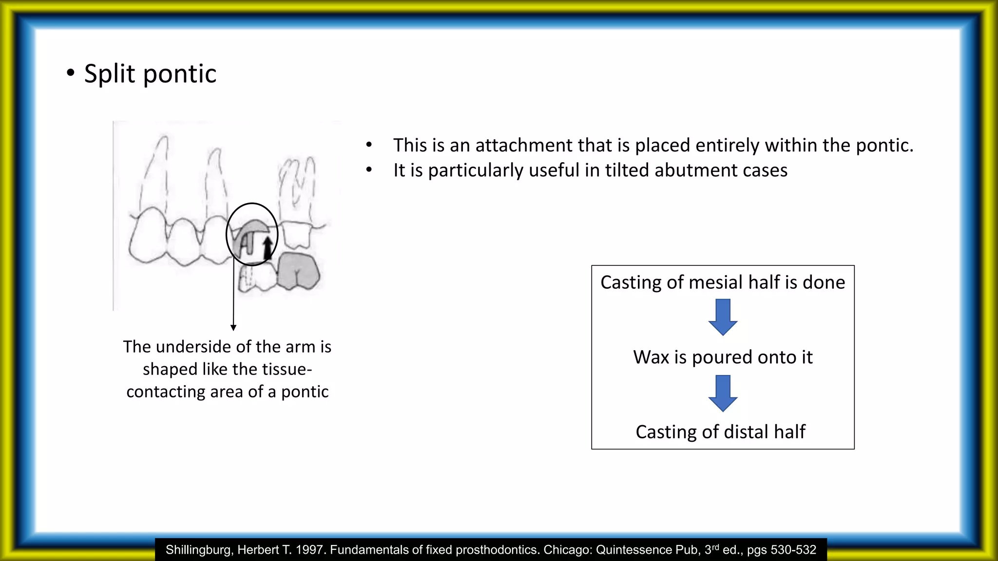 • Split pontic
• This is an attachment that is placed entirely within the pontic.
• It is particularly useful in tilted abutment cases
The underside of the arm is
shaped like the tissue-
contacting area of a pontic
Casting of mesial half is done
Wax is poured onto it
Casting of distal half
Shillingburg, Herbert T. 1997. Fundamentals of fixed prosthodontics. Chicago: Quintessence Pub, 3rd ed., pgs 530-532
 