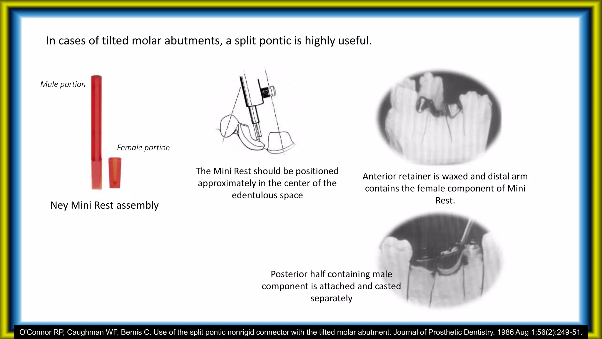 In cases of tilted molar abutments, a split pontic is highly useful.
Ney Mini Rest assembly
The Mini Rest should be positioned
approximately in the center of the
edentulous space
Female portion
Male portion
Anterior retainer is waxed and distal arm
contains the female component of Mini
Rest.
Posterior half containing male
component is attached and casted
separately
O'Connor RP, Caughman WF, Bemis C. Use of the split pontic nonrigid connector with the tilted molar abutment. Journal of Prosthetic Dentistry. 1986 Aug 1;56(2):249-51.
 