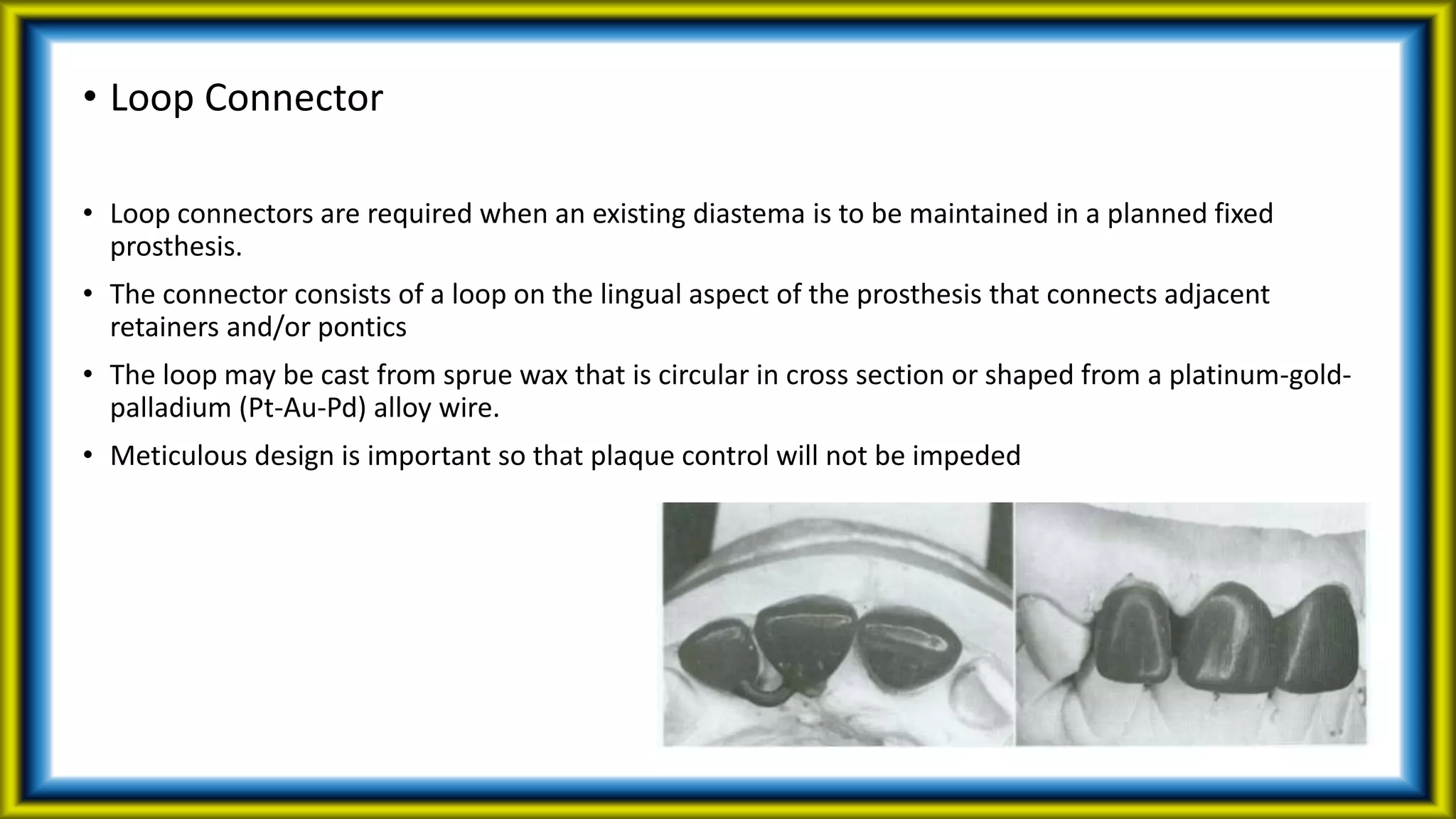 • Loop Connector
• Loop connectors are required when an existing diastema is to be maintained in a planned fixed
prosthesis.
• The connector consists of a loop on the lingual aspect of the prosthesis that connects adjacent
retainers and/or pontics
• The loop may be cast from sprue wax that is circular in cross section or shaped from a platinum-gold-
palladium (Pt-Au-Pd) alloy wire.
• Meticulous design is important so that plaque control will not be impeded
 