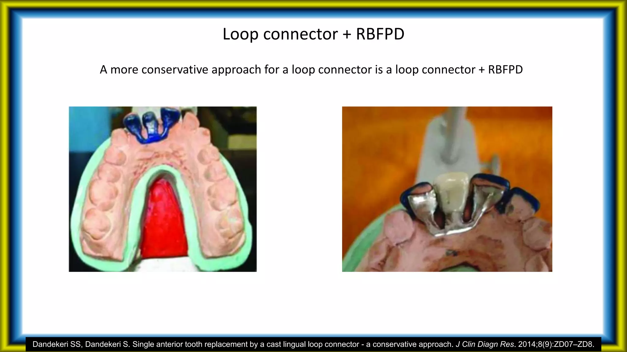 Loop connector + RBFPD
A more conservative approach for a loop connector is a loop connector + RBFPD
Dandekeri SS, Dandekeri S. Single anterior tooth replacement by a cast lingual loop connector - a conservative approach. J Clin Diagn Res. 2014;8(9):ZD07–ZD8.
 