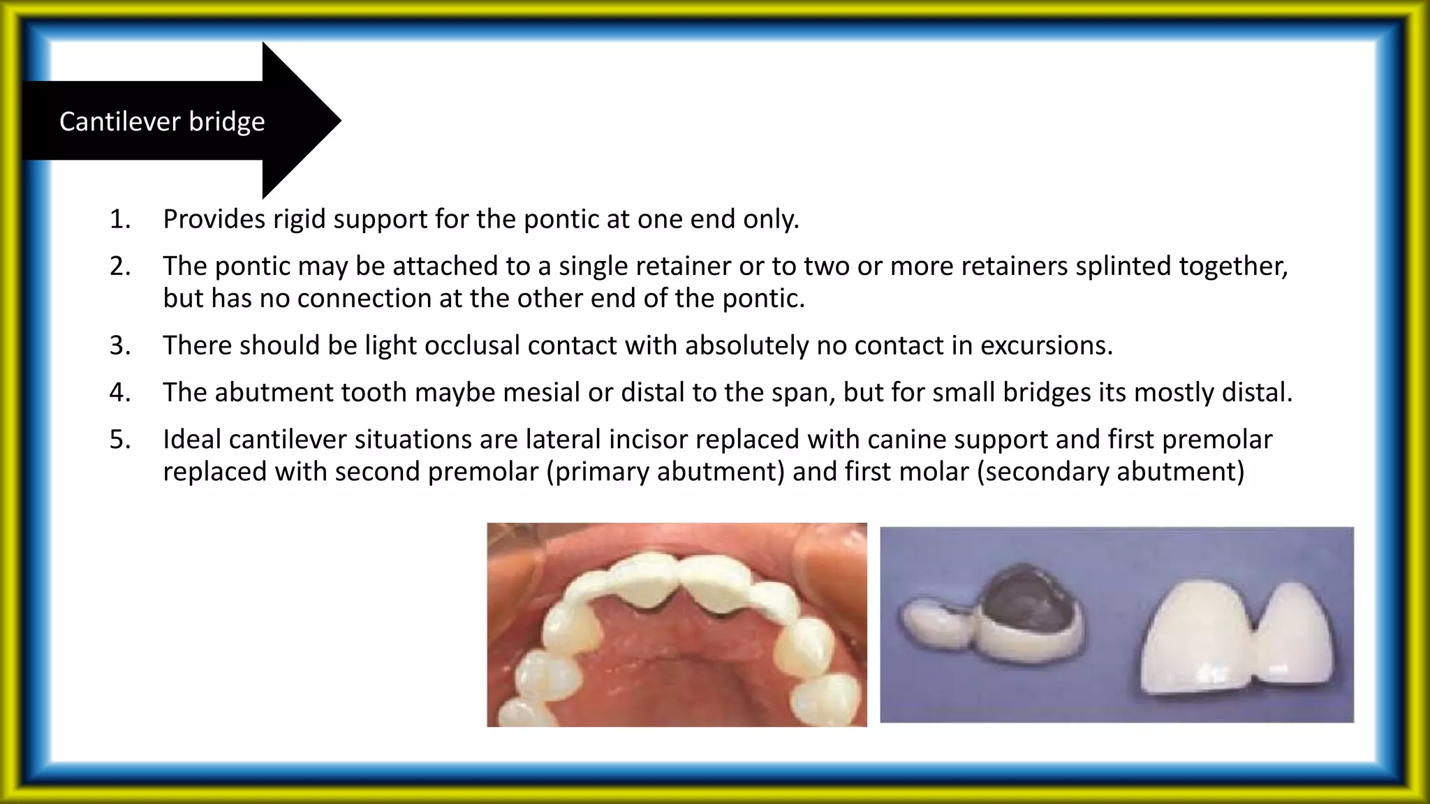 1. Provides rigid support for the pontic at one end only.
2. The pontic may be attached to a single retainer or to two or more retainers splinted together,
but has no connection at the other end of the pontic.
3. There should be light occlusal contact with absolutely no contact in excursions.
4. The abutment tooth maybe mesial or distal to the span, but for small bridges its mostly distal.
5. Ideal cantilever situations are lateral incisor replaced with canine support and first premolar
replaced with second premolar (primary abutment) and first molar (secondary abutment)
Cantilever bridge
 